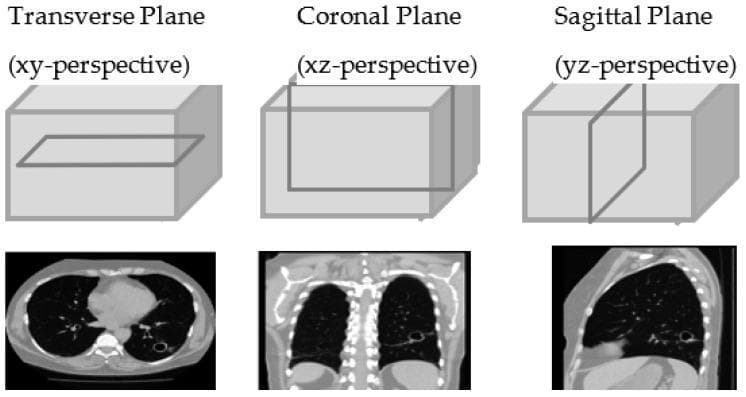 This diagnostic imaging illustration demonstrates the three primary anatomical planes of the human body using Computed Tomography (CT) of the chest. The top row features 3D diagrams of a rectangular volume representing the chest, with an intersecting plane highlighting the orientation for each perspective: Transverse (XY), Coronal (XZ), and Sagittal (YZ). Below these diagrams are corresponding 2D CT slices. The Transverse plane shows a horizontal cross-section of the thorax, displaying the bilateral lungs (dark areas), the central mediastinum including the heart, and the vertebral body. A focal cavitary lesion or nodule is visible in the left lung. The Coronal plane provides a frontal view, illustrating the vertical extent of the lungs, the diaphragm, and the spinal column. The Sagittal plane presents a lateral profile, showing the anterior-posterior depth of the lung, the rib cage, and the curvature of the diaphragm. These views are utilized for volumetric analysis and 3D reconstruction in clinical radiology, particularly for characterizing pulmonary pathology.