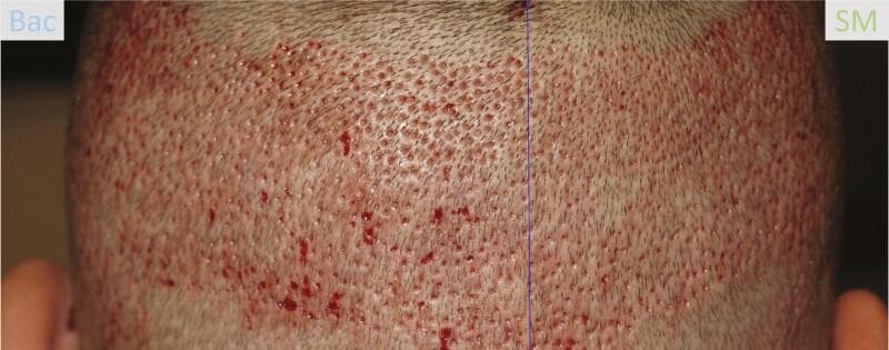 This clinical photograph displays a split-scalp comparison in a 41-year-old male patient two days after a Follicular Unit Extraction (FUE) hair transplant procedure. The image depicts the donor area of the scalp, characterized by a uniform distribution of numerous small, circular punctate wounds resulting from pneumatic hair follicle harvesting. A central blue line divides the scalp into two treatment zones: the left side labeled 'Bac' (treated with Bacitracin) and the right side labeled 'SM' (treated with Stratamed). The 'Bac' side shows more prominent areas of focal erythema and serosanguinous crusting at the extraction sites. In contrast, the 'SM' side exhibits a drier appearance with less visible discharge, suggesting accelerated initial wound healing and clot formation. This visual is used in dermatology and hair restoration education to evaluate post-procedural wound care protocols and compare the efficacy of topical treatments in reducing post-operative erythema and promoting re-epithelialization.