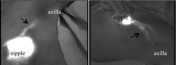 This diagnostic fluorescence image displays two patterns of subcutaneous lymphatic drainage pathways in the human breast, visualized using Indocyanine Green (ICG) fluorescence. Both images demonstrate a high-intensity fluorescent signal at the nipple/subareolar region, representing the injection site. From this origin, linear and slightly tortuous fluorescent streams—indicated by dashed arrows—course towards the axilla (axillary basin). The left image depicts a relatively direct and well-defined pathway, while the right image shows a more diffuse and wider lymphatic channel, potentially illustrating variations in individual anatomy or the merging of multiple lymphatic vessels. The clinical significance of this imagery is the real-time identification of sentinel lymph node drainage pathways, essential for oncological surgical planning and staging. These findings highlight the primary lymphatic flow from the mammary gland towards the axillary lymph nodes, which is a key concept in surgical oncology and breast cancer management.