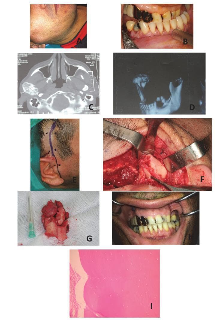 A multi-panel medical collage documenting a case of peripheral osteoma of the mandibular condyle. Panels A and B show clinical presentation, featuring right pre-auricular swelling and an associated malocclusion with a posterior open bite and mandibular midline deviation. Radiographic diagnostic imaging is provided in panels C (axial CT) and D (3D reconstruction), demonstrating a large, well-defined, radio-opaque osseous mass arising from the right mandibular condyle. Panels E and F illustrate the surgical management via a pre-auricular incision with temporal extension to expose the condylar lesion. Panel G shows the extirpated specimen, a lobulated bony mass. Post-operative outcome in panel H displays corrected dental occlusion. Panel I presents a histopathological micrograph (H&E stain, x200) showing the characteristic architecture of an osteoma, consisting of dense, compact mature bone with sparse osteocytes and well-defined borders. This sequence provides a comprehensive overview of the diagnostic pathway, surgical intervention, and pathological confirmation for benign condylar tumors.