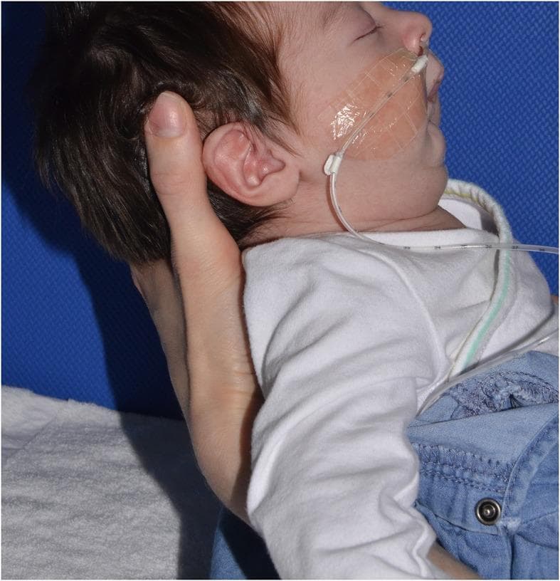 This clinical photograph shows a lateral (profile) view of an infant held in a half-sitting position, illustrating characteristic craniofacial features of Pierre Robin sequence (PRS). The primary finding is significant micrognathia and retrognathia, evidenced by a posteriorly displaced mandible. This results in the lower lip appearing recessed relative to the upper lip, a key clinical marker for assessing the severity of mandibular hypoplasia. A clear nasogastric or feeding tube is visible, entering through the nostril and secured to the right cheek with a transparent adhesive patch; numerical markings on the tube are visible, likely indicating insertion depth. The image demonstrates the neonatal presentation of PRS, which is typically characterized by the triad of micrognathia, glossoptosis, and often a cleft palate, potentially leading to airway obstruction and feeding difficulties. This visual is used in pediatrics and neonatology to teach physical examination techniques and the grading of mandibular recession in craniofacial anomalies.