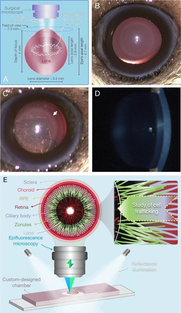 A multi-panel figure illustrating advanced imaging techniques for cataract evaluation and ocular immune cell trafficking. Panel A shows a schematic for dual illumination surgical microscopy, detailing optical parameters for visualizing an early cortical 'dotted ring' stage (~10µm microlesions). Panel B (bright-field) and C (stereo-microscopy) present clinical photographs of a lens with diabetic cataract; Figure C highlights hyper-reflective microlesions and posterior subcapsular cataract (PSC) with a white arrow. Panel D demonstrates the clinical limitation of slit-lamp biomicroscopy, where these microlesions lack sufficient contrast to be visible. Panel E contains a labeled anatomical diagram of the eye (sclera, choroid, RPE, retina, ciliary body, zonules, lens) and a schematic for an anterior half-globe microscopy setup. This method utilizes external reflectance illuminators and epifluorescence microscopy within a custom chamber to visualize cell trafficking along zonular fibers in 3D. The content serves as an educational comparison between standard clinical evaluation and novel microscopic techniques for early diabetic cataractogenesis research.