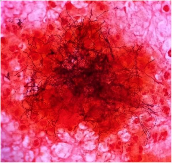 This light microscopy image demonstrates a Gram stain of an excised clinical sample, typically used in microbiology for diagnostic identification. The central focus shows a dense cluster of Gram-variable filamentous rods, characteristic of Actinomyces species. These organisms appear as dark, elongated, branching, thread-like structures. Some filaments exhibit a beaded appearance, staining more intensely (Gram-positive/purple) or less intensely (Gram-negative/pink) along their length. The background consists of host cellular debris and inflammatory cells, which are counterstained pink/red with safranin. These background elements include various eukaryotic cells and likely polymorphonuclear leukocytes. This visual is highly representative of Actinomycosis, demonstrating the classic 'sulfur granule' or 'tangled mass' morphology often seen in abscess aspirates or tissue samples. It serves as a critical educational tool for distinguishing filamentous bacteria from standard cocci or bacilli and highlights the importance of Gram stain variability in clinical diagnostics.