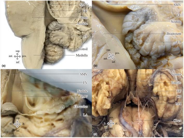 Educational clinical photographs of a formalin-fixed human brain dissection focusing on the anatomy of the fourth ventricle and hindbrain. (a) Midsagittal section showing the superior medullary velum (SMV), pons, medulla oblongata, and cerebellum components including the nodule and tonsil. (b) Close-up of the median aperture (MA) highlighting the choroid plexus (CP) as it relates to the vermis and brainstem. (c) Anterior view of the fourth ventricle with the brainstem retracted, revealing the flocculonodular lobe, inferior medullary velum (IMV), and lateral aperture (LA). (d) Inferior view demonstrating the median aperture as a gap bounded by the obex, vermis, and tela choroidea (TC). The images illustrate the complex three-dimensional relationships of the ventricular system roof and drainage points. Key structures include the choroid plexus, superior/inferior medullary vela, and cerebellar landmarks. This material is designed for advanced neuroanatomical education regarding the cerebrospinal fluid flow pathways and hindbrain morphology.
