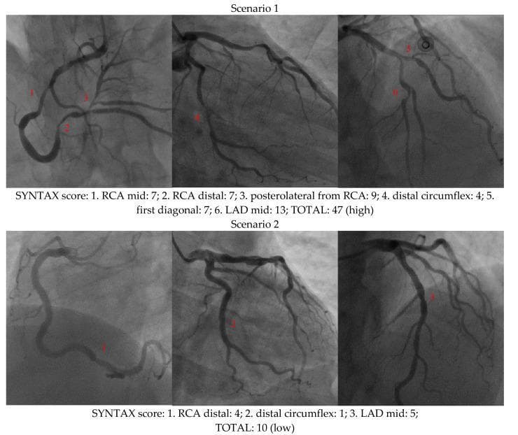 Diagnostic coronary angiography images comparing two clinical scenarios of coronary artery disease. The image is structured into two horizontal rows, each containing three angiographic views (likely RAO/LAO cranial and caudal projections) to visualize the Right Coronary Artery (RCA), Left Anterior Descending (LAD) artery, and Circumflex (LCx) artery. Scenario 1 (top row) demonstrates high-complexity multivessel disease with a total SYNTAX score of 47. Labeled lesions include the mid-RCA, distal RCA, posterolateral branch, distal circumflex, first diagonal, and mid-LAD, showing varying degrees of stenosis and vessel involvement. Scenario 2 (bottom row) illustrates low-complexity disease with a total SYNTAX score of 10, highlighting fewer and less severe lesions in the distal RCA, distal circumflex, and mid-LAD. These comparison images serve as an educational tool for cardiologists to understand coronary lesion scoring based on anatomical location, severity, and complexity to guide revascularization strategies (PCI vs. CABG).