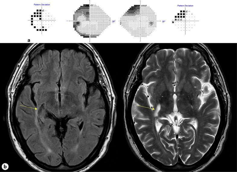 This composite educational image illustrates the correlation between diagnostic neuroimaging and visual field deficits. Panel (a) presents Humphrey 24-2 SITA-Fast perimetry results, displaying a clear left superior homonymous quadrantanopia (pie-in-the-sky defect) affecting the left upper quadrants of both eyes. Panel (b) features axial MRI brain scans in FLAIR (left) and T2-weighted (right) sequences. The MRI identifies an oblong, 2.0 × 0.5 cm cystic lesion posterior to the right basal ganglia, indicated by yellow arrows. The lesion is follows CSF signal intensity (hypointense on FLAIR, hyperintense on T2) and exhibits a thin hyperintense rim on the FLAIR sequence. Anatomically, the lesion is situated above the temporal horn of the lateral ventricle near the lateral geniculate body and Meyer's loop of the optic radiations. These findings are characteristic of a giant Virchow-Robin space (dilated perivascular space) causing mechanical disruption of the visual pathway. This material is essential for understanding neuro-ophthalmology, radiological anatomy of the optic radiations, and the clinical presentation of intracranial cystic lesions.
