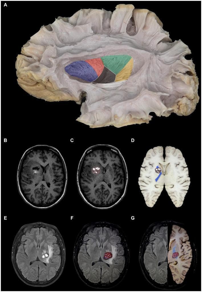 This composite educational graphic details the neuroanatomy of the internal capsule and its clinical correlation with cerebral cavernomas. Panel A features a gross anatomical white matter dissection (lateral view) with color-coded segmentation: anterior limb (blue), genu (red), posterior limb (green), retrolenticular portion (yellow), and sublenticular portion (white), alongside a partially resected lentiform nucleus. Panels B–D illustrate a cavernoma in the anterior limb of the internal capsule using axial T1-weighted MRI and anatomical overlays. The lesion demonstrates mixed signal intensity and is situated lateral to the caudate head and medial to the lentiform nucleus. Panels E–G depict a cavernoma in the posterior limb of the internal capsule via axial T2-weighted MRI and side-by-side anatomical comparisons. This lesion exhibits a heterogeneous, predominantly hyperintense signal and is localized medial to the lentiform nucleus and lateral to the thalamus. The collection serves to bridge gross anatomical segments of the internal capsule with diagnostic radiological findings and clinical pathology.