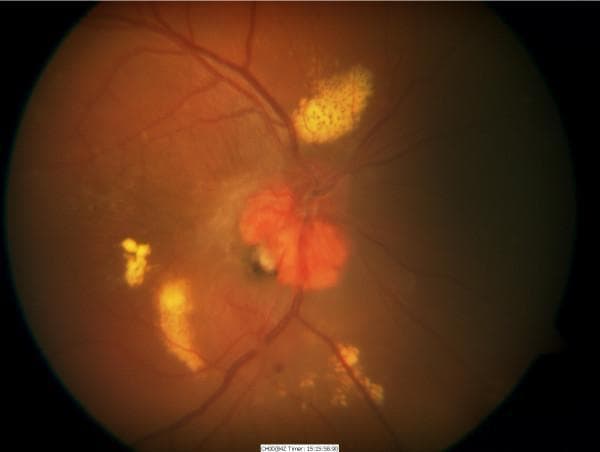 This clinical photograph displays a color fundus image of a right eye showing advanced manifestations of Von Hippel-Lindau (VHL) disease. The primary finding is a large, elevated, reddish-orange exophytic haemangioblastoma situated at the optic nerve head (peripapillary region). The lesion is associated with significant vascular alterations, including dilated and tortuous feeding vessels. Extensive, dense yellow hard exudates are visible in a circinate-like pattern and scattered clusters, particularly superior and temporal to the optic disc, indicating chronic lipid leakage. There is evidence of secondary serous retinal detachment evidenced by the hazy, elevated appearance of the peripapillary and macular retina. The image illustrates the progressive nature of retinal capillary hemangioblastomas and their potential to cause severe exudative maculopathy and visual impairment in patients with VHL syndrome. The photograph is an essential educational tool for ophthalmology trainees to identify peripapillary tumors and the associated secondary retinal changes.