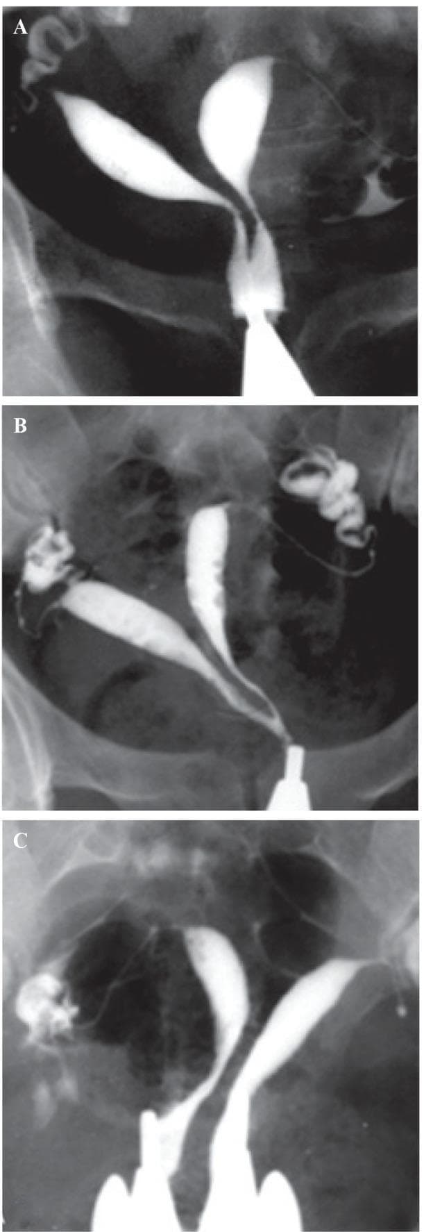 This composite of three fluoroscopic hysterosalpingography (HSG) images (A, B, and C) demonstrates varying degrees of a septate uterus, classified as American Fertility Society (AFS) Class V Müllerian duct anomalies. Each image shows radiopaque contrast material outlining the uterine cavities and cervical canals.
Image A illustrates a partial septum extending from the fundus to the lower internal os, resulting in two separate uterine horns that converge into a single cervical canal. Image B displays a more extensive septum reaching the external os, creating two distinct cervical canals that terminate at a single cervical opening. Image C demonstrates a complete septate uterus, often termed 'pseudodidelphys,' where the septum divides the entire length of the uterus and cervix, resulting in two completely separate uterine cavities and two distinct cervical canals. These images highlight the diagnostic role of HSG in characterizing the length and clinical significance of uterine septa, which is essential for differentiating them from bicornuate uteri and planning potential hysteroscopic resection.