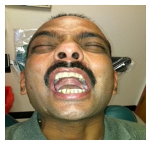 A frontal clinical photograph of an adult male patient demonstrating maximum mouth opening during a one-year postoperative follow-up for oral submucous fibrosis (OSMF). The patient is positioned in a dental chair with eyes closed. The oral cavity is visible, showing a functional interincisal distance of approximately 30 mm, consistent with successful surgical management of trismus. The upper and lower dentition are visible, alongside the tongue and oral mucosa. This image illustrates the long-term efficacy of surgical fibrous band excision and skin grafting in restoring masticatory function and mandibular mobility. The mucosal tissues appear pink and healthy without evidence of recurrent restrictive scarring or acute inflammation. This procedural outcome image is relevant for oral and maxillofacial surgery education, specifically regarding the rehabilitation of patients with progressive trismus secondary to betel nut or pan chewing habits.