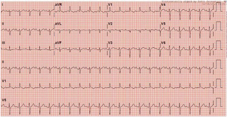 A 12-lead electrocardiogram (ECG) displayed on a standard red grid background, demonstrating sinus tachycardia with a heart rate exceeding 100 bpm. The frontal plane axis shows extreme right axis deviation, evidenced by a predominantly negative QRS complex in lead I and aVR, and positive deflections in leads II, III, and aVF. Key diagnostic features of right ventricular hypertrophy (RVH) are present, most notably a tall R wave in lead V1 (R/S ratio > 1) and a persistent deep S wave in lead V6. The precordial leads show a delayed R-wave progression. T-wave inversions are visible in the right precordial leads (V1-V3), which can be associated with a right ventricular strain pattern. This diagnostic image serves as a clinical example of cardiac electrical changes secondary to right heart pressure or volume overload, commonly seen in conditions such as pulmonary hypertension or severe myocarditis.