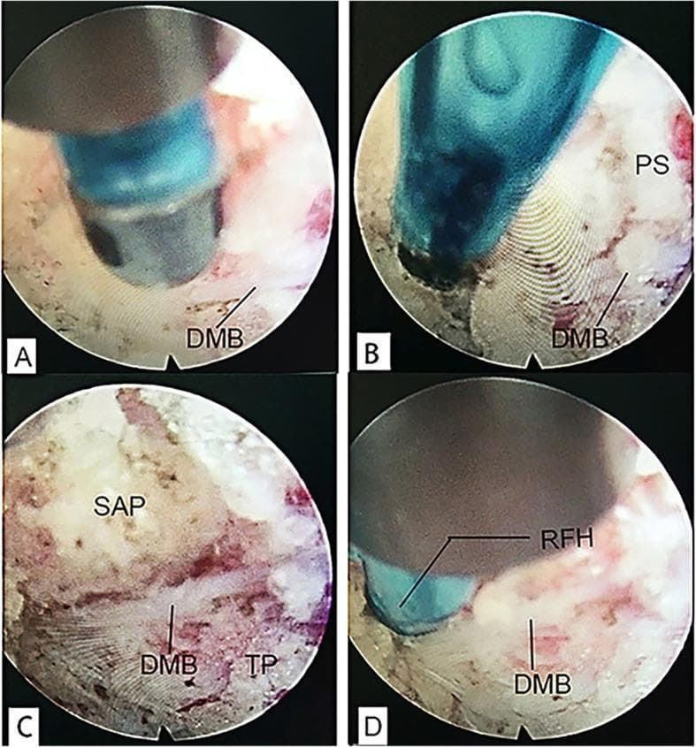 This set of four endoscopic clinical photographs (labeled a–d) illustrates the procedural steps for identifying and treating the dorsal medial branch (DMB) of the spinal nerve during endoscopic radiofrequency ablation for chronic low back pain. Panel A shows the initial exposure of the DMB. Panel B highlights the nerve as it is embedded within the thick periosteum (PS). Panel C demonstrates the critical anatomical landmarks at the junction of the superior articular process (SAP) and the transverse process (TP) base, where the DMB is typically situated. The SAP appears as a mottled, reddish-white bony surface, while the TP shows a lighter, striated texture. Panel D depicts the application of a radiofrequency head (RFH) to the DMB for neurotomy. These images serve as an educational guide for spinal surgeons and interventional pain specialists to understand the endoscopic anatomy and target localization required for facet joint denervation.