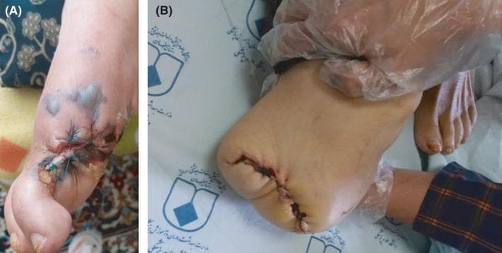 Two-panel clinical photograph demonstrating progressive infectious necrosis and subsequent surgical management in a diabetic patient. Panel A shows a dorsal view of a right foot featuring a grade 3, stage D lesion localized to the hallux (big toe). The area displays extensive tissue necrosis, dark eschar, and surgical sutures indicating a prior intervention. Multiple fluid-filled bullae and purplish-gray ecchymotic patches are visible on the dorsal midfoot, suggesting spreading infection. Panel B displays the same limb following a transmetatarsal or forefoot amputation. The surgical stump is closed with primary sutures, though the incision line appears dark and potentially necrotic. The remaining skin of the foot is pale. A gloved hand is shown stabilizing the amputated limb against a clinical background. These images illustrate the rapid progression of a fungal infection (Sarocladium spp.) requiring escalating surgical debridement and amputation in an immunocompromised, diabetic host.