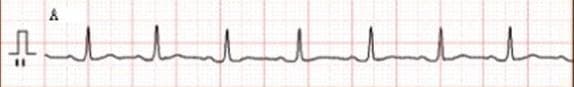 This diagnostic image shows a single-lead (Lead II) electrocardiogram (ECG) rhythm strip printed on standard grid paper. The tracing demonstrates a normal sinus rhythm with a heart rate of approximately 97-100 beats per minute. Each cardiac cycle consists of a discernible P wave, indicating atrial depolarization, followed by a narrow, sharply peaked QRS complex representing ventricular depolarization. The R-R intervals are regular, and the QRS amplitude is consistent across the strip. Following each QRS complex is a shallow, upright T wave representing ventricular repolarization. The ST segment remains at the isoelectric line, showing no evidence of elevation or depression. A standard calibration pulse is visible at the far left. The baseline exhibits minor undulations, but all waveform components (P, QRS, and T) are clearly identifiable, confirming a baseline cardiac status before therapeutic intervention in a clinical oncology setting.