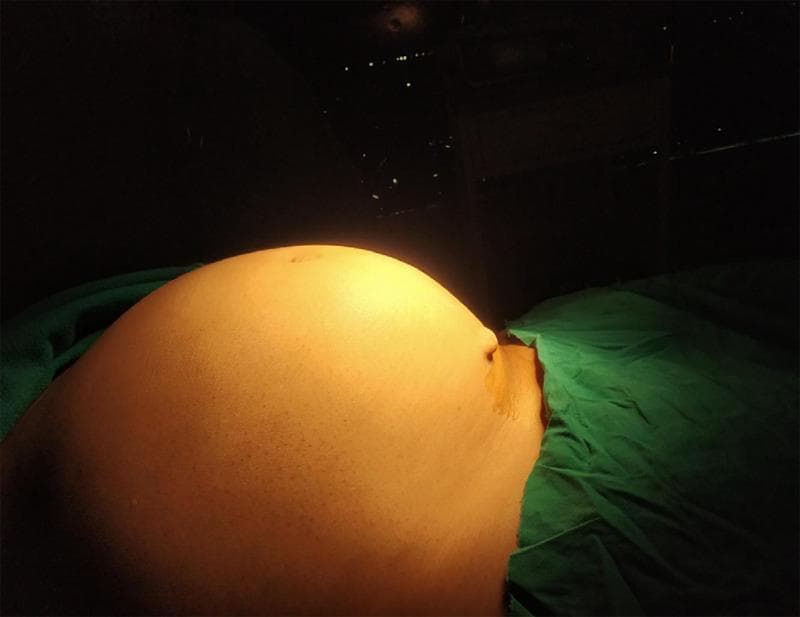 Clinical photograph of a patient in a supine position showing massive abdominal distension. The abdomen is symmetrically enlarged, presenting a rounded, protruding contour clinically comparable to a 32-week gravid uterus. The overlying skin is smooth, taut, and under tension, with a visible umbilicus. A green surgical drape is positioned over the lower abdomen, indicating a preoperative or intraoperative setting. This image illustrates severe abdominal enlargement caused by a large uterine leiomyoma (fibroid), demonstrating the clinical presentation of significant pelvic-abdominal masses that require surgical intervention such as laparotomy and hysterectomy. The photograph serves as an educational example of the physical examination findings associated with giant uterine fibroids and the resulting mass effect on the abdominal cavity.
