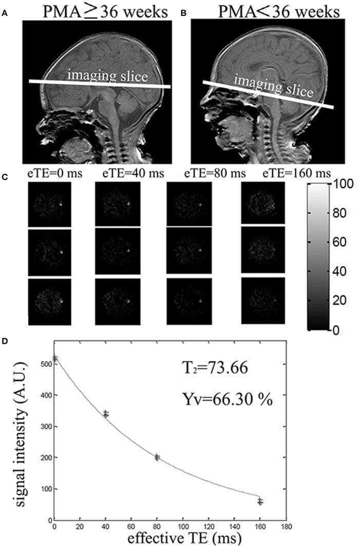 This composite educational image illustrates the methodology for measuring venous oxygenation (Yv) using T2-Relaxation-Under-Spin-Tagging (TRUST) MRI in neonates. Panels A and B display sagittal neonatal brain MRIs with white lines indicating imaging slice placement based on postmenstrual age (PMA). For PMA ≥ 36 weeks (A), the slice is positioned superiorly targeting the superior sagittal sinus. For PMA < 36 weeks (B), the slice is placed inferior to the sinus confluence to target the transverse or sigmoid sinuses. Panel C shows difference images (control minus label) at four effective echo times (eTE: 0, 40, 80, 160 ms), demonstrating the decay of venous signal intensity in the target voxel. Panel D presents a monoexponential decay curve fitting signal intensity (A.U.) against eTE. The derived parameters shown are T2 = 73.66 and Yv = 66.30%. This figure demonstrates how functional MRI can non-invasively quantify brain physiology and oxygen metabolism in the developing neonatal brain.