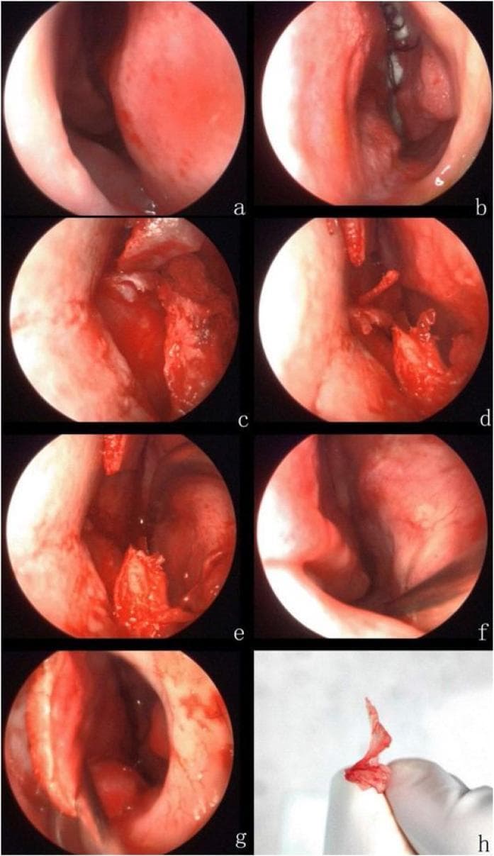 A multi-panel series of intraoperative endoscopic photographs and a clinical specimen photograph illustrating the steps of an endoscopic septoplasty for a deviated nasal septum.
Panels (a) and (b) show the preoperative right and left nasal cavities, respectively, with (a) demonstrating a prominent septal deviation to the right accompanied by an obstructive horizontal spur. Panels (c) through (g) document the surgical progression: (c) demonstrates the Killian incision and elevation of the mucoperichondrium; (d) and (e) show the progressive separation and resection of the deviating septal bone and offending spur; (f) confirms the integrity of the contralateral right nasal mucosa after resection; and (g) displays the repositioned (reset) septal mucosa following correction. Panel (h) provides a gross photograph of the excised septal bone and spur specimen.
The series serves as an educational guide for Otorhinolaryngology residents on the surgical management of nasal airway obstruction, highlighting anatomical landmarks such as the nasal septum, mucosal flaps, and the junction between septal cartilage and bone.
