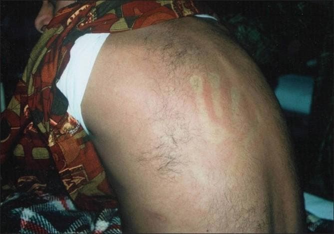This clinical photograph displays a diffuse exanthematous rash on a patient's torso, characteristic of the later stages of Dengue Fever. The image reveals generalized, confluent erythema that covers a broad anatomical area. A hallmark diagnostic feature is visible: the presence of multiple, small, rounded 'islands of sparing'—pale, unaffected areas of skin that stand out against the erythematous background, often referred to as 'white islands in a sea of red.' Additionally, there is evidence of dermatographism or linear erythematous streaks, likely resulting from pressure or scratching. This cutaneous manifestation typically appears 3–6 days after the onset of fever and represents a key clinical sign for differentiating Dengue Fever from other tropical febrile illnesses. The rash serves as an important educational example of viral exanthems and their unique morphological patterns in infectious disease and dermatology.
