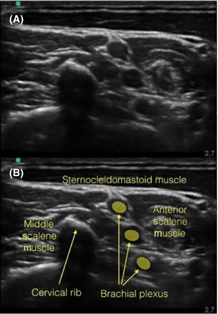 This diagnostic image displays two panels (A and B) of a musculoskeletal ultrasound scan in the cervical region, specifically showing an interscalene approach to the brachial plexus. Image A is the original sonogram, while image B provides anatomical labels. Key structures include the hypoechoic, rounded nerve roots of the brachial plexus located in the interscalene groove between the anterior scalene muscle and the middle scalene muscle. Superficial to these is the sternocleidomastoid muscle. A significant clinical finding is the presence of a cervical rib, which appears as a prominent, irregular hyperechoic structure. This osseous variation is seen casting a dense acoustic shadow that obscures the underlying neural anatomy, potentially complicating regional anesthesia procedures such as a brachial plexus block. The educational focus is on the ultrasonographic identification of anatomical variations and their impact on clinical interventions like nerve blocks.