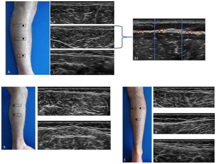 This composite educational image illustrates ultrasound (US) imaging of the lower leg musculature and fascia across three anatomical compartments: anterior (A), lateral (B), and posterior (C). Clinical photographs accompany the US scans, showing the probe orientation and levels (Ant 1-3, Lat 1-2, Post 1-3) used for data collection. The grayscale ultrasound images demonstrate high-frequency linear probe findings of skeletal muscle and overlying fascial layers. Key features include the crural fascia (highlighted with red/yellow markers) and epimysial fascia. Image b1 provides a detailed methodological visualization of fascial thickness measurement: the ultrasound frame is divided into three equal sections by vertical blue lines, with nine specific measurement points identified by red and yellow indicators to ensure objective data averaging. The anterior compartment scans (a, b, c) show the tibialis anterior muscle texture and fascial boundaries, while posterior scans (f, g, h) depict the layered architecture of the gastrocnemius and soleus muscles. This image is used to teach standardized ultrasonographic assessment of myofascial structures and thickness quantification in clinical research.