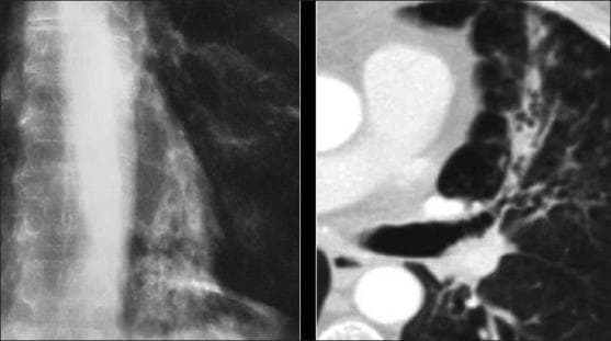 This composite diagnostic image features a side-by-side comparison of a chest X-ray (left) and a computed tomography (CT) scan (right) from a patient with Allergic Bronchopulmonary Aspergillosis (ABPA). The chest X-ray demonstrates increased reticular opacities and areas of consolidation, particularly concentrated in the lower lobes, which are characteristic of chronic inflammatory changes and infection. The axial CT scan on the right provides a more detailed view of the lung parenchyma, highlighting significant bronchial dilation consistent with bronchiectasis. A key diagnostic feature shown is mucus impaction within the dilated airways, creating the classic 'finger-in-glove' appearance, where dense mucoid material fills the bronchial lumen. These findings illustrate the typical radiographic progression of ABPA, showing the relationship between airway remodeling (bronchiectasis) and functional obstruction (airway impaction) in the context of a hypersensitivity response to Aspergillus species.