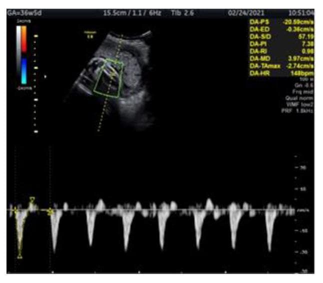 This diagnostic image is a Doppler ultrasound showing a longitudinal assessment of the fetal tibial artery in a 36-week and 5-day gestation fetus with intrauterine growth restriction (IUGR). The top portion displays a grayscale B-mode image of the fetal lower extremity with a superimposed color Doppler box highlighting blood flow within the tibial artery; red and blue hues indicate the direction of flow relative to the transducer. The bottom portion features a pulse-wave Doppler spectral waveform showing highly pulsatile flow with a high-resistance pattern. Numerical hemodynamic indices are displayed on the right, including a peak systolic velocity (PS) of -20.58 cm/s and a pathologically elevated pulsatility index (PI) of 7.38, which is above the 95th percentile for gestational age. The clinical significance of this finding in an IUGR context is its role as a potential early indicator of fetal hemodynamic redistribution or deteriorating fetal condition when conventional arterial markers may still appear normal.