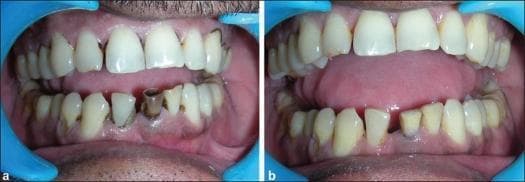 This comparative intraoral clinical photograph illustrates a pre-operative and post-operative case of a non-vital discolored mandibular left central incisor. Image (a) depicts the pre-operative state, showing severe intrinsic brownish-black discoloration and visible structural damage to the mandibular left central incisor, contrasting sharply with the adjacent natural dentition. This type of localized discoloration is characteristic of pulp necrosis or previous trauma. Image (b) shows the clinical result after three sessions of non-vital bleaching (walking bleach technique) using 35% hydrogen peroxide followed by composite resin restoration. The post-operative view demonstrates a significant metamorphosis, where the previously discolored tooth now exhibits a shade and translucency that harmoniously matches the surrounding mandibular teeth. The primary educational concept illustrated is the effectiveness of internal bleaching for restoring aesthetics in traumatized, non-vital anterior teeth.