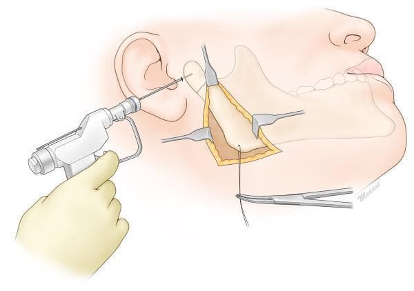 This medical anatomical diagram illustrates the surgical reduction of a mandibular condylar neck fracture using the Risdon approach. The illustration depicts a lateral view of the human face with a surgical incision below the mandibular angle, exposing the posterior ramus and subcondylar region. Three retractors are positioned to maintain the surgical field, providing direct visualization of the fracture site and the masseter muscle detachment. A threaded Kirschner wire (K-wire) is being inserted percutaneously through a preauricular stab incision into the proximal fractured condylar segment using a handheld power drill. Simultaneously, a wire traction technique is demonstrated at the inferior border of the mandibular angle, secured by a hemostat, to pull the distal segment inferiorly for anatomic alignment. This procedure is commonly used in oral and maxillofacial surgery for pediatric or complex condylar fractures to facilitate reduction under direct vision while minimizing risks to the facial nerve branches, specifically the marginal mandibular nerve.