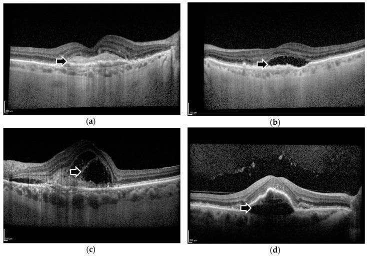 This set of four cross-sectional Spectral-Domain Optical Coherence Tomography (SD-OCT) images of the macula illustrates key biomarkers associated with neovascular age-related macular degeneration (nAMD). Image (a) demonstrates subretinal hyper-reflective material (SHRM), appearing as an irregular, dense, bright mass situated between the neurosensory retina and the retinal pigment epithelium (RPE). Image (b) shows subretinal fluid (SRF), characterized by a distinct hyporeflective (dark) pocket of fluid separating the photoreceptor layer from the RPE. Image (c) displays intraretinal fluid (IRF), visualized as multiple dark cystoid spaces within the inner and outer retinal layers, indicating retinal edema. Image (d) depicts a pigment epithelial detachment (PED), where the RPE is elevated from Bruch’s membrane, forming a dome-shaped space containing fluid or fibrovascular tissue. These biomarkers are critical for diagnostic classification, monitoring disease activity, and evaluating treatment response to anti-VEGF therapies in ophthalmology. The images highlight the differences in reflectivity and anatomical localization essential for identifying exudative retinal disease.