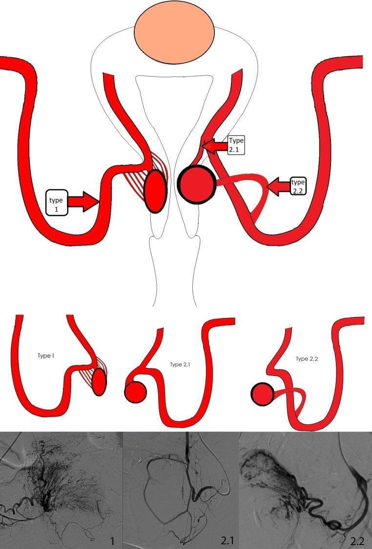 This composite educational graphic illustrates the vascular anatomy and angiographic classification of afferent branching arteries supplying cervical leiomyomata, essential for Uterine Artery Embolization (UAE). The top section features an anatomical diagram of the uterus and cervix with three distinct vascular patterns labeled. Type 1 represents an arterial plexus of multiple small feeding branches; Type 2.1 shows a solitary feeding branch originating proximally from the ascending uterine artery; and Type 2.2 depicts a solitary feeding branch originating distally. Red arrows and boxes indicate the target catheter positions for super-selective embolization for each type. The middle section provides simplified schematic drawings of these three vascular architectures. The bottom row presents corresponding Digital Subtraction Angiography (DSA) frames. Angiogram 1 displays a dense, complex network of tortuous vessels (plexus), while Angiograms 2.1 and 2.2 show more discrete, single-vessel supply paths. This material is designed for interventional radiologists to guide catheter placement and optimize clinical outcomes in the treatment of cervical fibroids.