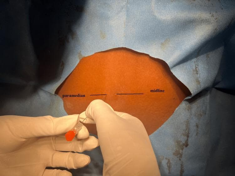 A clinical photograph depicting a patient's lower back prepared for a neuraxial procedure, likely a spinal anesthesia or lumbar puncture. The patient is draped in blue sterile material with a central rectangular exposure of the skin. Two black horizontal line markers are visible on the skin, labeled 'midline' and 'paramedian' to distinguish between different technical approaches to the subarachnoid space. A medical professional, wearing sterile white gloves, is shown inserting a spinal needle through the skin. The needle features an orange-coded hub, typically indicating a 25-gauge needle diameter. The needle is being advanced at the point corresponding to the 'paramedian' marker, demonstrating the lateral entry technique which bypasses the supraspinous and interspinous ligaments to access the spinal canal. This image serves as an educational resource for anesthesiology and neurology trainees to understand surface anatomy and procedural needle placement for spinal blocks.