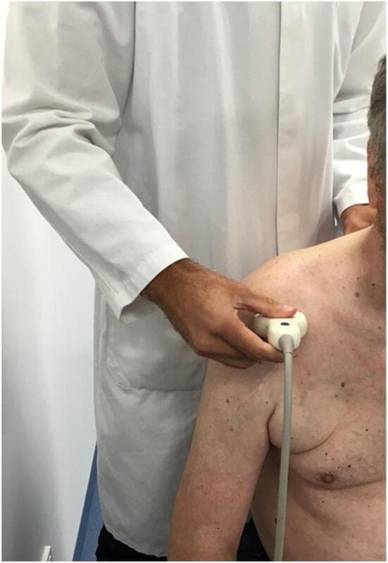 A clinical photograph demonstrating a point-of-care ultrasound (POCUS) examination of the shoulder, specifically for postoperative orthopedic assessment. A clinician in a white coat is shown holding a multi-lobed ultrasound transducer against the patient's right shoulder, positioned over the glenohumeral joint and proximal humerus region. The patient is a male with fair skin, displaying age-related changes such as mottled pigmentation, skin laxity, and multiple benign nevi across the chest and upper arm. The visual context illustrates the assessment of tendon integrity (such as the subscapularis) following shoulder arthroplasty or rotator cuff repair. This procedural image highlights the transducer's orientation and skin contact point required to evaluate musculoskeletal (MSK) structures, subacromial space, and tendon mobility during passive or active humeral rotation.