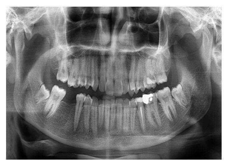 A panoramic radiograph (orthopantomogram) of the maxilla and mandible, illustrating a full dentition with various dental restorations. The image displays the anatomical landmarks including the temporomandibular joints, maxillary sinuses, and the mandibular canal. A primary focus is on the left mandibular second premolar, which features a highly radiopaque coronal restoration and a distinct radiopaque linear filling within the root canal, consistent with endodontic treatment. The periapical region of this premolar shows normal bone density and a well-defined lamina dura, indicating the complete resolution of a previous periapical lesion. Other visible features include endodontic fillings in several molars and the presence of third molars in varying stages of eruption. The cortical bone of the mandible appears continuous, and the trabecular pattern is consistent throughout, demonstrating successful post-treatment healing in a clinical follow-up context.