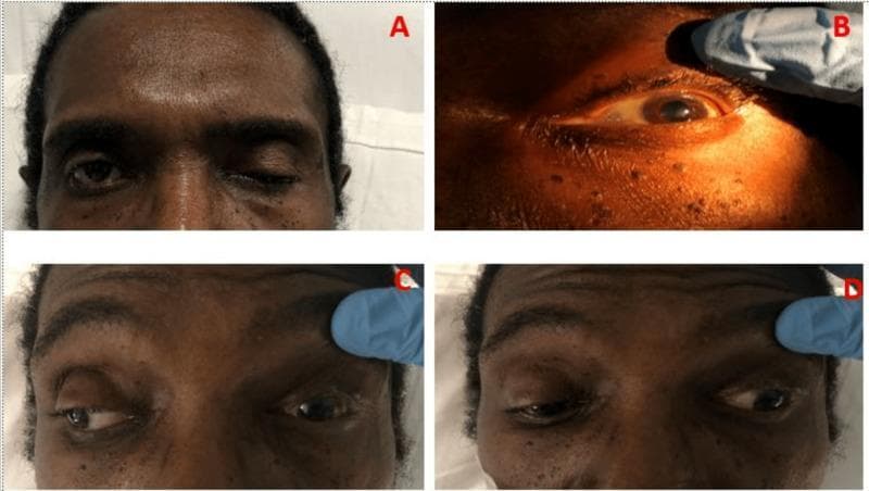 A composite of four clinical photographs (A-D) demonstrating a complete left-sided oculomotor nerve (CN III) palsy in an adult male. Panel A illustrates severe ptosis of the left upper eyelid. Panel B shows the left eye with the eyelid manually elevated, revealing fixed mydriasis (dilated pupil). Panel C displays a deficit in adduction; when the patient attempts a rightward gaze, the right eye moves medially while the left eye remains stationary or fails to cross the midline. Panel D shows the characteristic 'down and out' resting position of the left eye, exhibiting both exotropia and hypotropia. These findings are consistent with compression or damage to the third cranial nerve, affecting the levator palpebrae superioris, the pupillary sphincter (parasympathetic fibers), and the medial rectus, superior rectus, inferior rectus, and inferior oblique muscles. The presentation is clinically relevant for diagnosing conditions such as pituitary apoplexy or intracranial aneurysms.