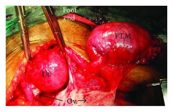 This clinical surgical photograph captures an intraoperative view of the female pelvic anatomy during a surgical procedure, specifically highlighting primary fallopian tube carcinoma. The image shows three major labeled structures: the uterus (Ut.), which appears as a reddish, spherical organ held by surgical retractors; the right ovary (Ov.), visible as a smaller, whitish, oval-shaped structure situated inferiorly; and a significant right tubal mass (FT.M). The tubal mass is markedly enlarged, elongated, and exhibits a hyperemic, irregular surface texture compared to the smoother uterus. Surgical instruments and retractors are positioned to expose the adnexa and uterine corpus. Annotations including 'Foot end' provide anatomical orientation. The image illustrates the gross morphological appearance of an adnexal mass that has originated from the fallopian tube, demonstrating its size relative to normal pelvic organs and its high vascularity, which are key diagnostic indicators for gynecologic oncology. This visual serves as an educational reference for distinguishing tubal pathology from primary ovarian or uterine lesions during laparotomy.