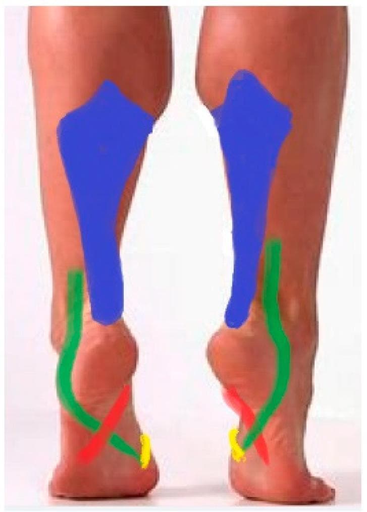 This clinical photograph with anatomical overlays illustrates the extrinsic muscles of the lower leg and foot that stabilize the longitudinal and transverse arches (System III). The image shows a posterior view of both legs in a heel-rise position. Color-coded regions highlight specific muscle systems: the triceps surae (blue) dominates the posterior calf, acting as the primary flexor and invertor via the Achilles tendon. The m. fibularis longus (green) runs laterally, wrapping under the foot to cross the plantar surface. The m. tibialis posterior (red) is shown wrapping around the medial malleolus. On the plantar aspect of the foot, the intersection of the fibularis longus (green) and tibialis posterior (red) is visible, demonstrating the anatomical 'crossing' mechanism that stabilizes the posterior transverse arch. The m. tibialis anterior (yellow) is partially visible on the medial aspect. This visual highlights the functional synergy between these antagonists in shaping the medial longitudinal arch and stiffening the foot into a rigid lever for gait propulsion.