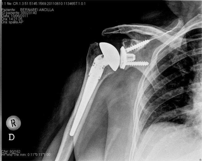 This anterior-posterior (AP) X-ray of the right shoulder demonstrates a Total Shoulder Arthroplasty (TSA). The humeral component is a stemmed metallic prosthesis with high radiopacity, extending into the medullary canal of the humerus. The proximal humeral head is replaced with a hemispherical metallic component. The glenoid component is a metal-backed design, indicated by its distinct radiopaque baseplate and visible fixation hardware. Two radiopaque cancellous screws are seen extending from the glenoid baseplate into the scapular neck to provide primary mechanical stability. A central peg or keel-like structure is also visible at the center of the glenoid component. The articulation between the humeral head and the glenoid liner appears well-maintained. This image serves as an educational example of third-generation modular shoulder prostheses and the radiographic evaluation of surgical hardware positioning, cement interfaces, and bone-implant integration.