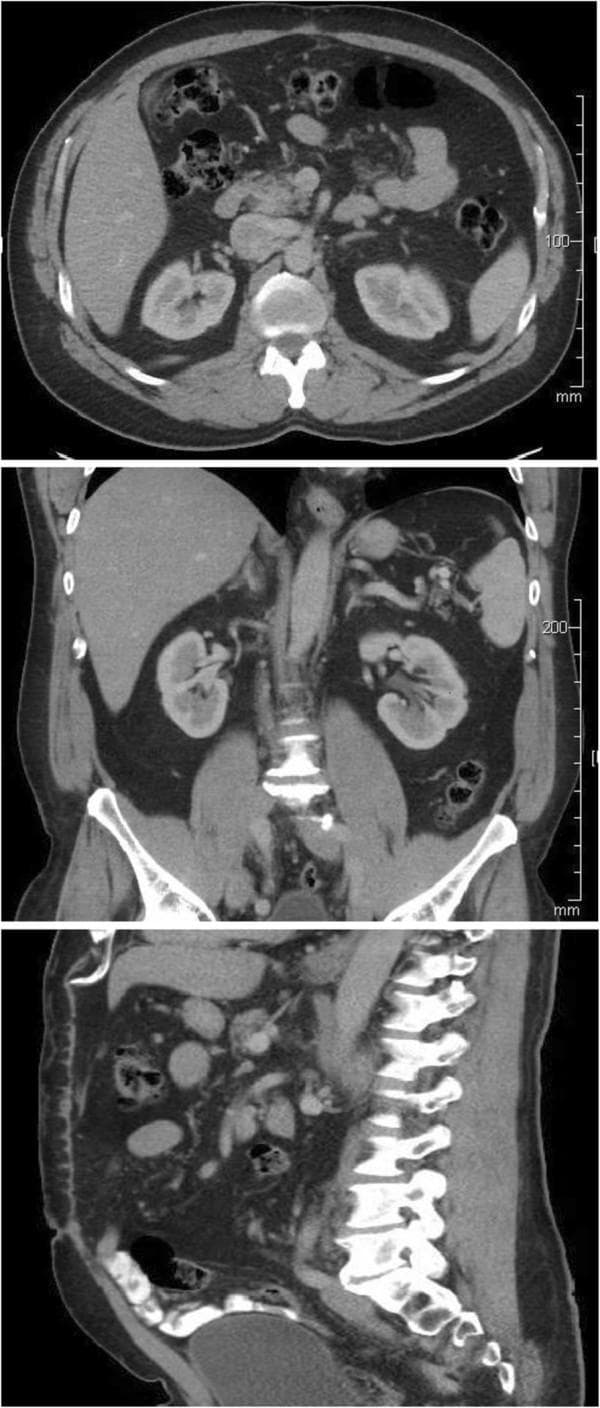This diagnostic image displays a series of three post-operative computed tomography (CT) scans of the abdomen and pelvis in axial (top), coronal (middle), and sagittal (bottom) planes. The axial view demonstrates the transverse anatomy of the mid-abdomen, highlighting the liver, both kidneys in their retroperitoneal positions, and the vertebral body. The coronal view offers a longitudinal perspective of the abdominal cavity, showing the anatomical relationship between the liver, bilateral kidneys, spleen, and the iliac crests of the pelvis. The sagittal view provides a lateral profile of the lumbar spine and the distribution of the bowel and bladder. The images illustrate a normal anatomical configuration following the surgical resection of a large retroperitoneal mass. There is no evidence of residual cystic lesions or recurrence. Key structures such as the aorta and inferior vena cava appear in their expected midline and para-midline positions, and the bowel has returned to a normal anatomical distribution after previously being displaced. This series serves as an educational example of post-operative surveillance imaging to confirm successful surgical outcomes and the absence of disease recurrence.