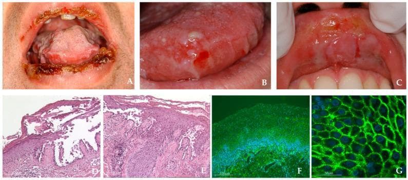 This composite image illustrates clinical and diagnostic features of Mucosal Pemphigus Vulgaris (MPV). Panels A-C are clinical photographs of the oral cavity: (A) shows extensive hemorrhagic crusting and erosions on the vermilion border of both lips; (B) demonstrates multiple small, intact blisters and shallow erosions on the lateral and dorsal tongue; (C) highlights an erosive lesion on the upper labial mucosa with a characteristic collapsed bulla roof appearing as a white slough. Panels D-E are histopathological images (H&E stain, 40x magnification) showing classic suprabasal clefting and intraepidermal bulla formation with acantholysis, where keratinocytes lose adhesion. Panels F-G present direct immunofluorescence (DIF) microscopy at 10x and 40x magnification. These panels demonstrate a diagnostic 'fishnet' or reticular staining pattern, indicating intercellular IgG/C3 deposits or Dsg3 autoantibodies along the keratinocyte cell surfaces. This collection serves as a comprehensive educational tool for the diagnosis of autoimmune blistering diseases through clinical presentation, histopathology, and immunofluorescent confirmation.