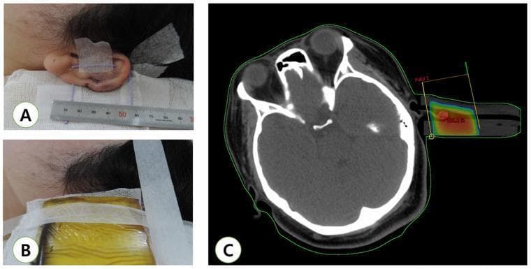 A multi-panel figure illustrating the workflow for adjuvant radiotherapy of an earlobe keloid following surgical excision. Image A is a clinical photograph showing the immediate post-operative state of the earlobe, featuring surgical sutures and medical tape for positioning, with a millimeter ruler included for precise dimensional measurement. Image B displays the simulation phase for radiotherapy, showing a bolus material applied over the surgical site to ensure optimal surface dose distribution. Image C is an axial Computed Tomography (CT) scan used for treatment planning. The CT shows transverse cross-sections of the cranium and orbits. Superimposed on the left earlobe region is a color-coded dose-volume histogram (DVH) representation, with red indicating the high-dose target area and yellow contours defining the radiation field boundaries, labeled 'Field 1'. This composite image demonstrates the integration of clinical surgery, simulation, and radiological planning in dermatology and radiation oncology.