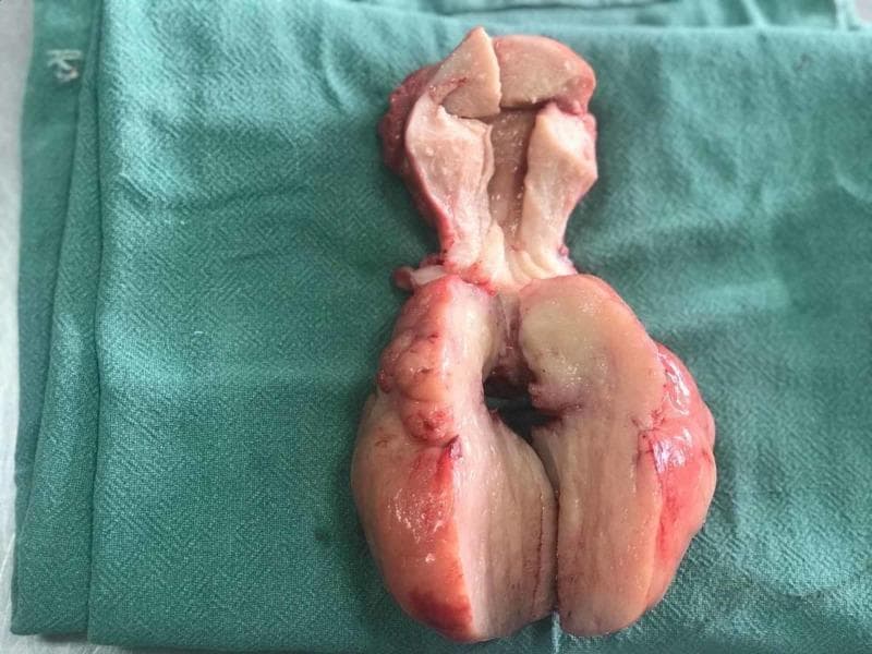 This clinical photograph displays a gross surgical specimen of a human uterus post-hysterectomy, specifically showing a longitudinal cut-section. The specimen features a bulky uterine corpus and a prominent, prolapsed fleshy fibroid. The external serosal surface is lobulated with a pinkish-red, vascular appearance. The internal cut surfaces reveal a relatively homogeneous, pale pink-to-tan tissue with a smooth and regular texture, characteristic of a uterine leiomyoma (fibroid). The lower portion of the image highlights the rounded, well-circumscribed nature of the mass. This visual is an educational example of gynecological pathology, specifically illustrating a large submucosal or pedunculated fibroid polyp that has caused significant uterine enlargement. It is relevant for medical training in surgical pathology and clinical gynecology, demonstrating the morphological characteristics that differentiate benign leiomyomas from other myometrial lesions.