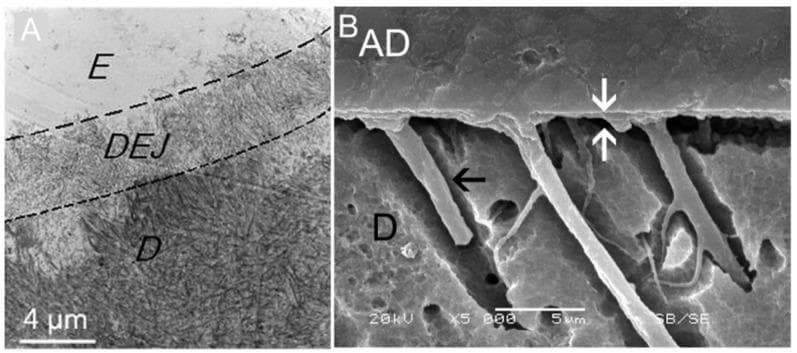 This figure presents two Scanning Electron Microscopy (SEM) microphotographs illustrating natural and artificial dental interfaces. Image A shows a cross-section of the natural dentinoenamel junction (DEJ), marked by dashed lines, which serves as a transitional interface between the highly mineralized enamel (E) and the more granular dentin (D). A scale bar of 4 µm is provided for reference. Image B demonstrates the resin-dentin interface achieved through dental bonding. The adhesive (AD) layer is visible at the top, forming a hybrid layer (indicated by white arrows) where the resin interdiffuses with the dentin (D). A prominent black arrow identifies a resin tag, where adhesive material has successfully penetrated into a dentinal tubule to provide micromechanical retention. The images compare the biomimetic integration of natural structures with the artificial adhesion used in restorative dentistry. Key educational concepts include dental histology, adhesive dentistry, and the morphology of the hybrid layer.