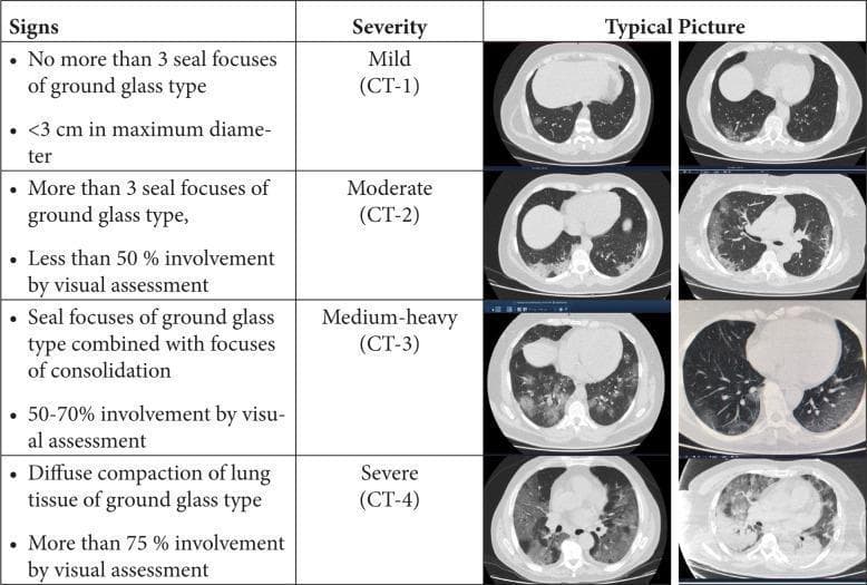 A comparison chart and diagnostic imaging series illustrating a radiological scoring system for pneumonia severity based on axial chest CT scans. The content is categorized into four stages of lung involvement: CT-1 (Mild), CT-2 (Moderate), CT-3 (Medium-heavy), and CT-4 (Severe). CT-1 is characterized by minimal focal ground-glass opacities (GGOs) under 3 cm. CT-2 shows more than three GGOs with less than 50% parenchymal involvement. CT-3 demonstrates a combination of GGOs and pulmonary consolidation, involving 50-70% of the lung volume. CT-4 represents the most severe stage, with diffuse compaction of lung tissue and GGOs or consolidation affecting over 75% of the lung. Representative CT images for each stage highlight the progression from peripheral, patchy opacities to widespread, bilateral, and dense consolidation. This resource serves as a clinical assessment tool for grading the extent of inflammatory lung disease, commonly utilized in the context of viral pneumonias such as COVID-19.