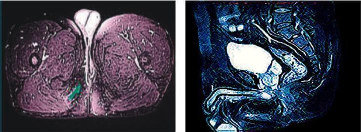 This medical image displays two false-colored pelvic CT scans used for anorectal evaluation. Image (a) on the left is an axial cross-section of the upper thighs and perineum, presented in a pinkish hue. It shows the gluteal and adductor musculature, with a specific focus on the perianal region where a suspected anal fistula or abscess is highlighted with a green digital overlay. Image (b) on the right is a sagittal reconstruction in a blue hue, visualizing the lumbosacral spine, the rectum, and a contrast-filled urinary bladder appearing as a bright white hyperdense structure. The images are used to compare standard diagnostic quality in a control group versus an optimized experimental group, specifically for mapping fistula tracks, identifying internal openings, and assessing involvement of the perianal sphincters. These scans assist in surgical planning for anorectal conditions by delineating the relationship between pathology and surrounding pelvic anatomy.