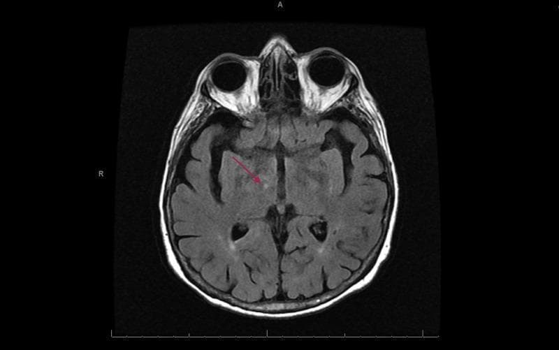 This diagnostic image is an axial T2-weighted (FLAIR-like) MRI of the brain, demonstrating a focal area of pathology. A red arrow points to a small, well-defined hyperintense signal abnormality located in the right thalamus. This lesion is characteristic of an acute to subacute lacunar infarct, a type of small vessel ischemic stroke. The surrounding neuroanatomy, including the basal ganglia, internal capsule, and ventricular system, appears structurally intact with preserved morphology. The image also captures the anterior orbital structures, including the globes and optic nerves. This clinical imaging is essential for medical students and neurology residents to identify the radiological presentation of deep gray matter ischemia and small vessel disease. The educational focus is on the localization of lacunar syndromes and the characteristic high-signal intensity on T2-weighted sequences during the acute phase of cerebral infarction.