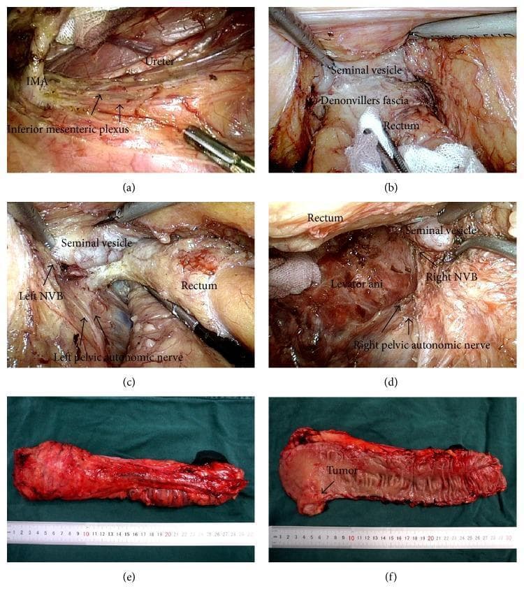This composite figure consists of six images (a-f) documenting laparoscopic Total Mesorectal Excision (TME) for rectal cancer in an obese patient and the subsequent surgical specimens. Panels (a) through (d) are intraoperative clinical photographs showing key anatomical landmarks and surgical steps: (a) medial-to-lateral dissection with skeletonization of the inferior mesenteric artery (IMA), identification of the ureter, and preservation of the inferior mesenteric plexus; (b) exposure of the anterior rectal space, seminal vesicles, and dissection of the anterior layer of Denonvilliers' fascia; (c) and (d) demonstrate the bilateral 'holy plane' of dissection with identification and protection of the left and right neurovascular bundles (NVB) and pelvic autonomic nerves near the levator ani. Panels (e) and (f) are macroscopic photographs of the resected rectal specimens. Image (e) shows a specimen with a circumferential, intact mesorectal fascia, representing a high-quality TME. Image (f) shows a opened specimen revealing a primary rectal tumor that has decreased to 1.5 cm following neoadjuvant chemoradiotherapy (nCRT), with a clear distal resection margin. These images highlight standard surgical oncological principles for colorectal surgery.