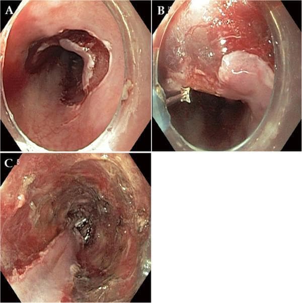 This set of three endoscopic images (A-C) illustrates the sequential stages of an Endoscopic Submucosal Dissection (ESD) procedure for esophageal squamous cell carcinoma. Image A shows the initial pre-cutting phase, where circumferential mucosal incisions are made around the outer border of the target lesion, resulting in visible tissue disruption and minor bleeding. Image B depicts the submucosal dissection phase; an endoscopic knife is visible in the field as it separates the lesion from the muscularis propria, with clear visualization of the submucosal plane. Image C captures the post-procedural state, revealing a large iatrogenic ulcer spanning approximately three-fourths of the esophageal circumference. The ulcer base is irregular, showing exposed submucosa with areas of hyperemic and dark necrotic tissue, characteristic of a comprehensive en bloc resection. This series is an educational example of advanced gastrointestinal therapeutic endoscopy, highlighting the transition from surgical planning to the final iatrogenic defect.