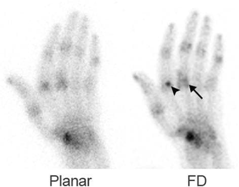 This diagnostic comparison image demonstrates 99mTc-MDP bone scintigraphy of the hand in a 71-year-old male with rheumatoid arthritis. The left panel shows a routine planar NaI(Tl) scan, while the right panel displays a full-dose (FD) cadmium zinc telluride (CZT) detector scan. Both images exhibit multiple areas of increased radiotracer uptake corresponding to active joint inflammation. The CZT scan provides significantly higher spatial resolution and contrast, allowing for better visualization of anatomic structures and focal pathologies. Specifically, the FD CZT image clearly reveals increased uptake localized to both sides of the joint space in the third metacarpophalangeal (MCP) joint (indicated by an arrow). Additionally, a discrete focal point of tracer activity at the MCP region of the index finger is identified as a sesamoid bone (indicated by an arrowhead). The image serves as an educational comparison of detector technology in nuclear medicine, illustrating how CZT-based imaging improves the detection of small articular structures and the characterization of multifocal tracer distribution in systemic inflammatory conditions like rheumatoid arthritis.