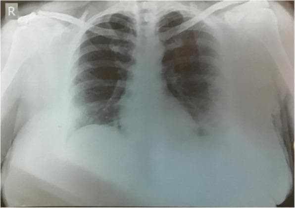 This diagnostic image is a posteroanterior (PA) chest X-ray demonstrating significant pulmonary pathology. The primary findings include extensive, bilateral ground-glass opacities (GGOs) distributed throughout both lung fields. These opacities appear as hazy areas of increased attenuation that do not completely obscure the underlying bronchial or vascular structures, though they exhibit a heterogeneous distribution with a apparent predilection for the middle and lower lung zones. In the left lung, there is a distinct area of consolidation, characterized by a more dense and confluent opacity compared to the surrounding hazy ground-glass areas. This pattern of multifocal ground-glass opacities and consolidation is highly characteristic of viral pneumonia, such as that seen in COVID-19. The mediastinal contour appears within normal limits, though the lower lung details are partially obscured by the increased density of the inflammatory process and potentially overlying soft tissue. The image serves as an educational example of typical radiographic manifestations of acute respiratory infections and the differentiation between hazy GGOs and dense pulmonary consolidation.