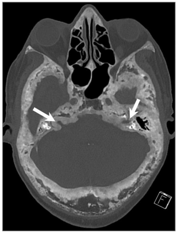 This axial CT image of the skull illustrates advanced Paget’s disease of the bone. The calvarium and skull base exhibit a characteristic 'cotton wool' appearance, defined by heterogeneous, mixed lytic and sclerotic areas. Notable pathological features include diffuse bone expansion, prominent cortical thickening, and coarsened, thickened trabeculae. White arrows specifically highlight the narrowing (stenosis) of the bilateral internal auditory canals (IACs) resulting from significant bony overgrowth and cortical expansion. The image demonstrates the progressive osseous deformity and remodeling typical of the mixed and sclerotic phases of Paget’s disease, which can lead to neurological complications such as cranial nerve entrapment or hearing loss due to foraminal and canal narrowing.